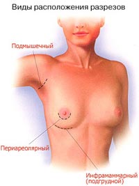 Увеличение груди Днепропетровск