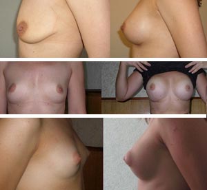 Увеличение грудных желез